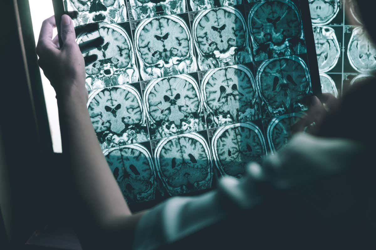 Brain scans that show signs of Alzheimer's disease